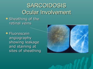 SARCOIDOSISSARCOIDOSIS
Ocular InvolvementOcular Involvement
 Sheathing of theSheathing of the
retinal veinsretinal veins
 FluoresceinFluorescein
angiographyangiography
showing leakageshowing leakage
and staining atand staining at
sites of sheathingsites of sheathing
 