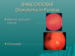 SARCOIDOSISSARCOIDOSIS
Granuloma in FundusGranuloma in Fundus
 Retinal and pre-Retinal and pre-
retinalretinal
 ChoroidalChoroidal
 