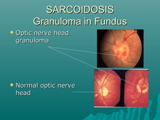 SARCOIDOSISSARCOIDOSIS
Granuloma in FundusGranuloma in Fundus
 Optic nerve headOptic nerve head
granulomagranuloma
 Normal optic nerveNormal optic nerve
headhead
 