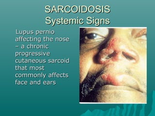 SARCOIDOSISSARCOIDOSIS
Systemic SignsSystemic Signs
Lupus pernioLupus pernio
affecting the noseaffecting the nose
– a chronic– a chronic
progressiveprogressive
cutaneous sarcoidcutaneous sarcoid
that mostthat most
commonly affectscommonly affects
face and earsface and ears
 
