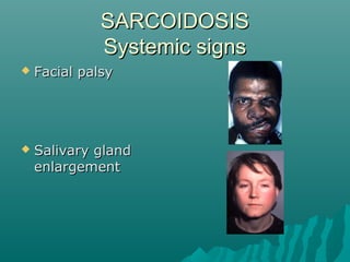 SARCOIDOSISSARCOIDOSIS
Systemic signsSystemic signs
 Facial palsyFacial palsy
 Salivary glandSalivary gland
enlargementenlargement
 