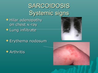 SARCOIDOSISSARCOIDOSIS
Systemic signsSystemic signs
 Hilar adenopathyHilar adenopathy
on chest x-rayon chest x-ray
 Lung infiltrateLung infiltrate
 Erythema nodosumErythema nodosum
 ArthritisArthritis
 