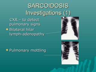 SARCOIDOSISSARCOIDOSIS
Investigations (1)Investigations (1)
CXR – to detectCXR – to detect
pulmonary signspulmonary signs
 Bilateral hilarBilateral hilar
lymph-adenopathylymph-adenopathy
 Pulmonary mottlingPulmonary mottling
 