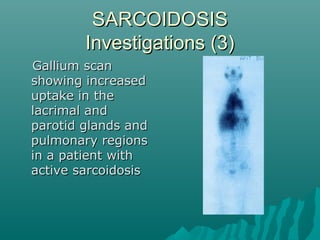 SARCOIDOSISSARCOIDOSIS
Investigations (3)Investigations (3)
Gallium scanGallium scan
showing increasedshowing increased
uptake in theuptake in the
lacrimal andlacrimal and
parotid glands andparotid glands and
pulmonary regionspulmonary regions
in a patient within a patient with
active sarcoidosisactive sarcoidosis
 