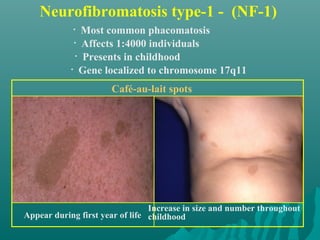 Neurofibromatosis type-1 - (NF-1)
Appear during first year of life
Café-au-lait spots
• Most common phacomatosis
Increase in size and number throughout
childhood
• Affects 1:4000 individuals
• Presents in childhood
• Gene localized to chromosome 17q11
 