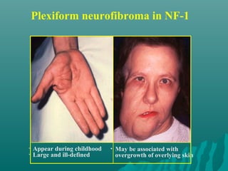 Plexiform neurofibroma in NF-1
• May be associated with
overgrowth of overlying skin
• Appear during childhood
• Large and ill-defined
 