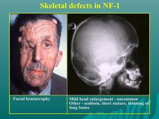 Skeletal defects in NF-1
• Mild head enlargement - uncommon
• Other - scoliosis, short stature, thinning of
long bones
• Facial hemiatrophy
 