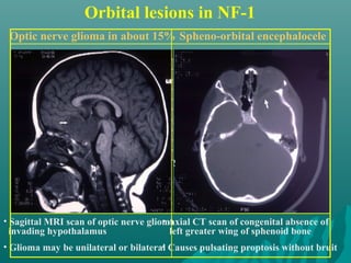 Orbital lesions in NF-1
Spheno-orbital encephaloceleOptic nerve glioma in about 15%
• Sagittal MRI scan of optic nerve glioma
invading hypothalamus
• Glioma may be unilateral or bilateral
• Axial CT scan of congenital absence of
left greater wing of sphenoid bone
• Causes pulsating proptosis without bruit
 