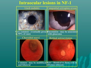 Intraocular lesions in NF-1
Lisch nodules
Very common - eventually present
in 95% of cases
Congenital ectropion uveae
Uncommon - may be associated
with glaucoma
Retinal astrocytomas
Rare - identical to those seen in
tuberous sclerosis
Choroidal naevi
Common - may be multifocal
and bilateral
 