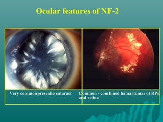 Ocular features of NF-2
Common - combined hamartomas of RPE
and retina
Very common -presenile cataract
 