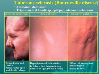 Tuberous sclerosis (Bourneville disease)
• Diffuse thickening over
lumbar region
• Present in 40%
Shagreen patches
• Autosomal dominant
• Triad - mental handicap, epilepsy, adenoma sebaceum
Adenoma sebaceum
• Around nose and
cheeks
• Appear after age 1
and slowly enlarge
Ash leaf spots
• Hypopigmented skin patches
• In infants best detected using
ultraviolet light (Wood’s lamp)
 