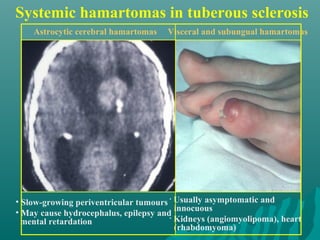 Systemic hamartomas in tuberous sclerosis
Astrocytic cerebral hamartomas
• Slow-growing periventricular tumours
• May cause hydrocephalus, epilepsy and
mental retardation
• Usually asymptomatic and
innocuous
• Kidneys (angiomyolipoma), heart
(rhabdomyoma)
Visceral and subungual hamartomas
 