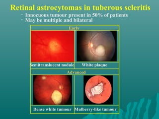 Retinal astrocytomas in tuberous scleritis
Dense white tumour Mulberry-like tumour
Early
• Innocuous tumour present in 50% of patients
• May be multiple and bilateral
Semitranslucent nodule White plaque
Advanced
 