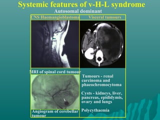 Systemic features of v-H-L syndrome
Autosomal dominant
• Tumours - renal
carcinoma and
phaeochromocytoma
• Cysts - kidneys, liver,
pancreas, epididymis,
ovary and lungs
• Polycythaemia
CNS Haemangioblastoma
MRI of spinal cord tumour
Angiogram of cerebellar
tumour
Visceral tumours
 