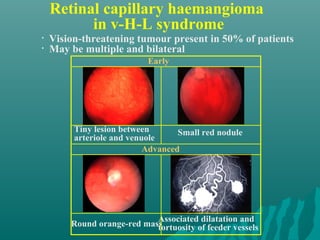Retinal capillary haemangioma
in v-H-L syndrome
Round orange-red mass
Early
• Vision-threatening tumour present in 50% of patients
• May be multiple and bilateral
Tiny lesion between
arteriole and venuole
Small red nodule
Associated dilatation and
tortuosity of feeder vessels
Advanced
 
