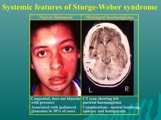 Systemic features of Sturge-Weber syndrome
• Congenital, does not blanche
with pressure
• Associated with ipsilateral
glaucoma in 30% of cases
Naevus flammeus
• CT scan showing left
parietal haemangioma
• Complications - mental handicap,
epilepsy and hemiparesis
Meningeal haemangioma
 
