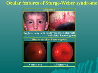 Ocular features of Sturge-Weber syndrome
Normal eye
Buphthalmos in 60%May be associated with
episcleral haemangioma
Affected eye
Diffuse choroidal haemangioma
Glaucoma
 