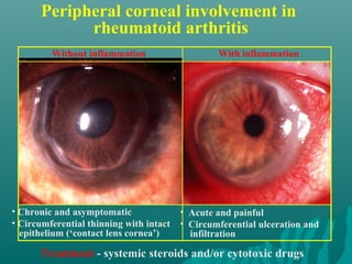Peripheral corneal involvement in
rheumatoid arthritis
• Chronic and asymptomatic
• Circumferential thinning with intact
epithelium (‘contact lens cornea’)
• Acute and painful
• Circumferential ulceration and
infiltration
Treatment - systemic steroids and/or cytotoxic drugs
Without inflammation With inflammation
 