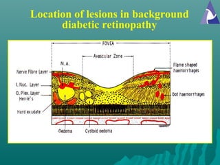 Location of lesions in background
diabetic retinopathy
 