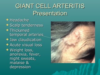GIANT CELL ARTERITISGIANT CELL ARTERITIS
PresentationPresentation
 HeadacheHeadache
 Scalp tendernessScalp tenderness
 ThickenedThickened
temporal arteriestemporal arteries
 Jaw claudicationJaw claudication
 Acute visual lossAcute visual loss
 Weight loss,Weight loss,
anorexia, fever,anorexia, fever,
night sweats,night sweats,
malaise &malaise &
depressiondepression
 