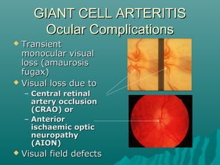 GIANT CELL ARTERITISGIANT CELL ARTERITIS
Ocular ComplicationsOcular Complications
 TransientTransient
monocular visualmonocular visual
loss (amaurosisloss (amaurosis
fugax)fugax)
 Visual loss due toVisual loss due to
– Central retinalCentral retinal
artery occlusionartery occlusion
(CRAO) or(CRAO) or
– AnteriorAnterior
ischaemic opticischaemic optic
neuropathyneuropathy
(AION)(AION)
 Visual field defectsVisual field defects
 