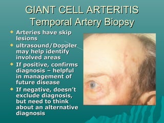 GIANT CELL ARTERITISGIANT CELL ARTERITIS
Temporal Artery BiopsyTemporal Artery Biopsy
 Arteries have skipArteries have skip
lesionslesions
 ultrasound/Dopplerultrasound/Doppler
may help identifymay help identify
involved areasinvolved areas
 If positive, confirmsIf positive, confirms
diagnosis – helpfuldiagnosis – helpful
in management ofin management of
future diseasefuture disease
 If negative, doesn’tIf negative, doesn’t
exclude diagnosis,exclude diagnosis,
but need to thinkbut need to think
about an alternativeabout an alternative
diagnosisdiagnosis
 