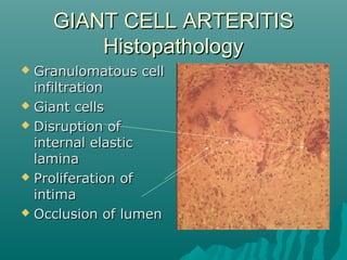 GIANT CELL ARTERITISGIANT CELL ARTERITIS
HistopathologyHistopathology
 Granulomatous cellGranulomatous cell
infiltrationinfiltration
 Giant cellsGiant cells
 Disruption ofDisruption of
internal elasticinternal elastic
laminalamina
 Proliferation ofProliferation of
intimaintima
 Occlusion of lumenOcclusion of lumen
 