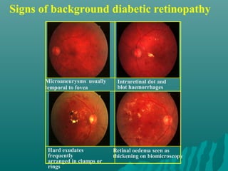 Signs of background diabetic retinopathy
Microaneurysms usually
temporal to fovea
Intraretinal dot and
blot haemorrhages
Hard exudates
frequently
arranged in clumps or
rings
Retinal oedema seen as
thickening on biomicroscopy
 