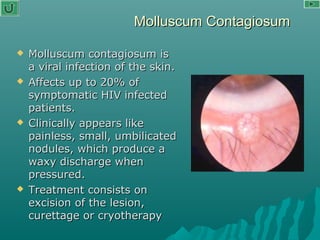 Molluscum ContagiosumMolluscum Contagiosum
 Molluscum contagiosum isMolluscum contagiosum is
a viral infection of the skin.a viral infection of the skin.
 Affects up to 20% ofAffects up to 20% of
symptomatic HIV infectedsymptomatic HIV infected
patients.patients.
 Clinically appears likeClinically appears like
painless, small, umbilicatedpainless, small, umbilicated
nodules, which produce anodules, which produce a
waxy discharge whenwaxy discharge when
pressured.pressured.
 Treatment consists onTreatment consists on
excision of the lesion,excision of the lesion,
curettage or cryotherapycurettage or cryotherapy
 