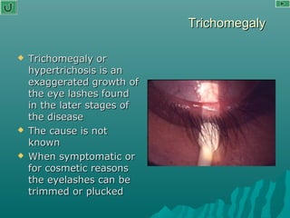 TrichomegalyTrichomegaly
 Trichomegaly orTrichomegaly or
hypertrichosis is anhypertrichosis is an
exaggerated growth ofexaggerated growth of
the eye lashes foundthe eye lashes found
in the later stages ofin the later stages of
the diseasethe disease
 The cause is notThe cause is not
knownknown
 When symptomatic orWhen symptomatic or
for cosmetic reasonsfor cosmetic reasons
the eyelashes can bethe eyelashes can be
trimmed or pluckedtrimmed or plucked
 