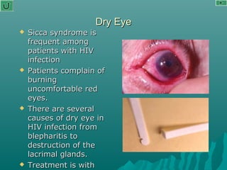 Dry EyeDry Eye
 Sicca syndrome isSicca syndrome is
frequent amongfrequent among
patients with HIVpatients with HIV
infectioninfection
 Patients complain ofPatients complain of
burningburning
uncomfortable reduncomfortable red
eyes.eyes.
 There are severalThere are several
causes of dry eye incauses of dry eye in
HIV infection fromHIV infection from
blepharitis toblepharitis to
destruction of thedestruction of the
lacrimal glands.lacrimal glands.
 Treatment is withTreatment is with
 