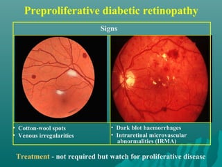 Preproliferative diabetic retinopathy
Treatment - not required but watch for proliferative disease
• Cotton-wool spots
• Venous irregularities
• Dark blot haemorrhages
• Intraretinal microvascular
abnormalities (IRMA)
Signs
 