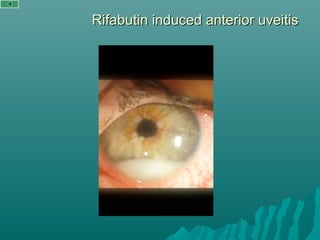 Rifabutin induced anterior uveitisRifabutin induced anterior uveitis
 