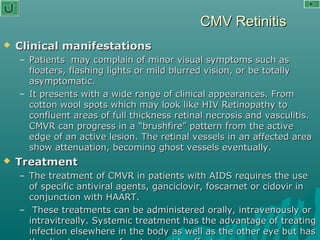 CMV RetinitisCMV Retinitis
 Clinical manifestationsClinical manifestations
– Patients may complain of minor visual symptoms such asPatients may complain of minor visual symptoms such as
floaters, flashing lights or mild blurred vision, or be totallyfloaters, flashing lights or mild blurred vision, or be totally
asymptomatic.asymptomatic.
– It presents with a wide range of clinical appearances. FromIt presents with a wide range of clinical appearances. From
cotton wool spots which may look like HIV Retinopathy tocotton wool spots which may look like HIV Retinopathy to
confluent areas of full thickness retinal necrosis and vasculitis.confluent areas of full thickness retinal necrosis and vasculitis.
CMVR can progress in a “brushfire” pattern from the activeCMVR can progress in a “brushfire” pattern from the active
edge of an active lesion. The retinal vessels in an affected areaedge of an active lesion. The retinal vessels in an affected area
show attenuation, becoming ghost vessels eventually.show attenuation, becoming ghost vessels eventually.
 TreatmentTreatment
– The treatment of CMVR in patients with AIDS requires the useThe treatment of CMVR in patients with AIDS requires the use
of specific antiviral agents, ganciclovir, foscarnet or cidovir inof specific antiviral agents, ganciclovir, foscarnet or cidovir in
conjunction with HAART.conjunction with HAART.
– These treatments can be administered orally, intravenously orThese treatments can be administered orally, intravenously or
intravitreally. Systemic treatment has the advantage of treatingintravitreally. Systemic treatment has the advantage of treating
infection elsewhere in the body as well as the other eye but hasinfection elsewhere in the body as well as the other eye but has
 
