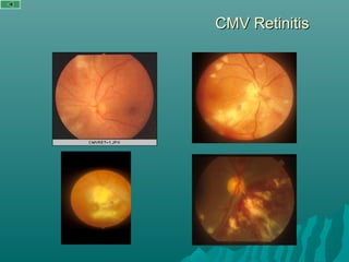 CMV RetinitisCMV Retinitis
 