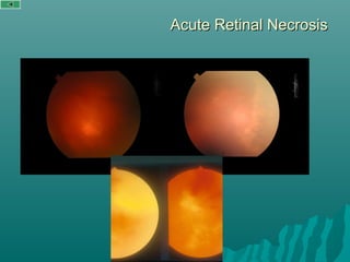 Acute Retinal NecrosisAcute Retinal Necrosis
 