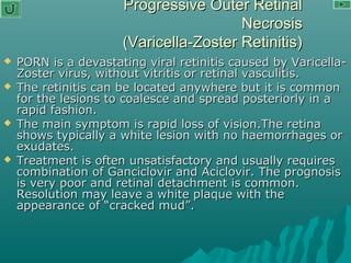 Progressive Outer RetinalProgressive Outer Retinal
NecrosisNecrosis
(Varicella-Zoster Retinitis)(Varicella-Zoster Retinitis)
 PORN is a devastating viral retinitis caused by Varicella-PORN is a devastating viral retinitis caused by Varicella-
Zoster virus, without vitritis or retinal vasculitis.Zoster virus, without vitritis or retinal vasculitis.
 The retinitis can be located anywhere but it is commonThe retinitis can be located anywhere but it is common
for the lesions to coalesce and spread posteriorly in afor the lesions to coalesce and spread posteriorly in a
rapid fashion.rapid fashion.
 The main symptom is rapid loss of vision.The retinaThe main symptom is rapid loss of vision.The retina
shows typically a white lesion with no haemorrhages orshows typically a white lesion with no haemorrhages or
exudates.exudates.
 Treatment is often unsatisfactory and usually requiresTreatment is often unsatisfactory and usually requires
combination of Ganciclovir and Aciclovir. The prognosiscombination of Ganciclovir and Aciclovir. The prognosis
is very poor and retinal detachment is common.is very poor and retinal detachment is common.
Resolution may leave a white plaque with theResolution may leave a white plaque with the
appearance of “cracked mud”.appearance of “cracked mud”.
 