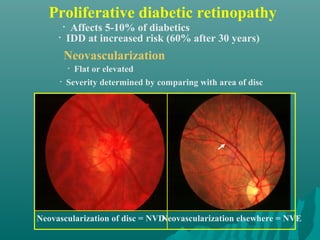 Proliferative diabetic retinopathy
• Flat or elevated
• Severity determined by comparing with area of disc
Neovascularization
Neovascularization of disc = NVD
• Affects 5-10% of diabetics
• IDD at increased risk (60% after 30 years)
Neovascularization elsewhere = NVE
 