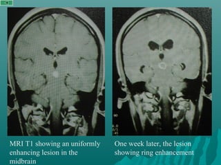 MRI T1 showing an uniformly
enhancing lesion in the
midbrain
One week later, the lesion
showing ring enhancement
 