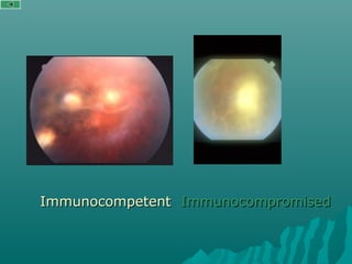 ImmunocompetentImmunocompetent ImmunocompromisedImmunocompromised
 