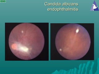 Candida albicansCandida albicans
endophthalmitisendophthalmitis
 