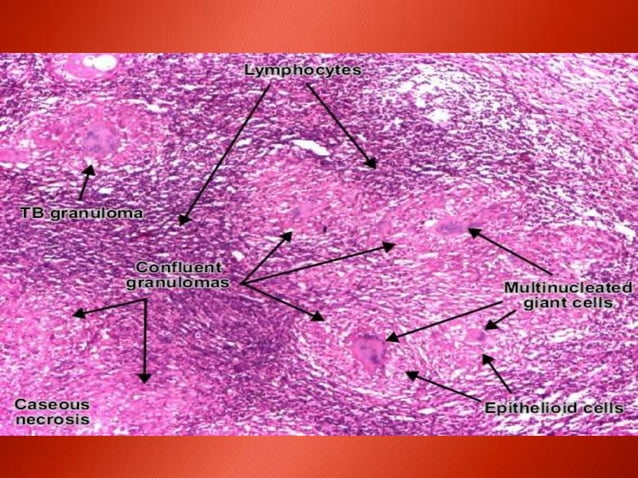 Systemic effects of acute inflammation and granuloma | PPTX | Blood ...