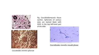 Systemic Fungal Infections and its dideases | PPTX