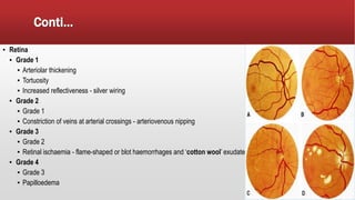 Conti…
▪ Retina
▪ Grade 1
▪ Arteriolar thickening
▪ Tortuosity
▪ Increased reflectiveness - silver wiring
▪ Grade 2
▪ Grade 1
▪ Constriction of veins at arterial crossings - arteriovenous nipping
▪ Grade 3
▪ Grade 2
▪ Retinal ischaemia - flame-shaped or blot haemorrhages and ‘cotton wool’ exudates
▪ Grade 4
▪ Grade 3
▪ Papilloedema
 