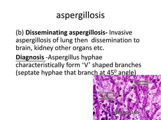 aspergillosis
(b) Disseminating aspergillosis- Invasive
aspergillosis of lung then dissemination to
brain, kidney other organs etc.
Diagnosis -Aspergillus hyphae
characteristically form ‘V’ shaped branches
(septate hyphae that branch at 450 angle)
 