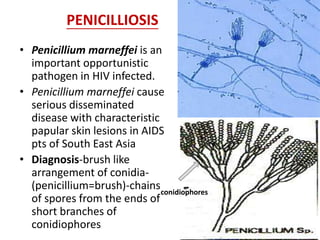 • Penicillium marneffei is an
important opportunistic
pathogen in HIV infected.
• Penicillium marneffei cause
serious disseminated
disease with characteristic
papular skin lesions in AIDS
pts of South East Asia
• Diagnosis-brush like
arrangement of conidia-
(penicillium=brush)-chains
of spores from the ends of
short branches of
conidiophores
conidiophores
PENICILLIOSIS
 
