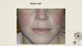 Malar Rash Pattern Systemic Lupus-erythmatosus a detailed review.pdf