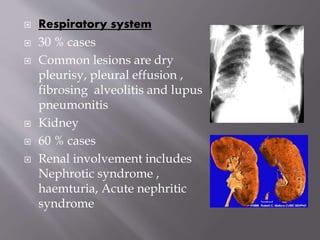  Respiratory system
 30 % cases
 Common lesions are dry
pleurisy, pleural effusion ,
fibrosing alveolitis and lupus
pneumonitis
 Kidney
 60 % cases
 Renal involvement includes
Nephrotic syndrome ,
haemturia, Acute nephritic
syndrome
 