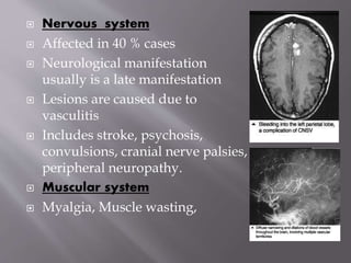  Nervous system
 Affected in 40 % cases
 Neurological manifestation
usually is a late manifestation
 Lesions are caused due to
vasculitis
 Includes stroke, psychosis,
convulsions, cranial nerve palsies,
peripheral neuropathy.
 Muscular system
 Myalgia, Muscle wasting,
 