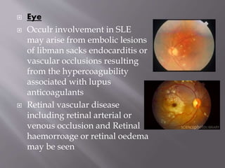  Eye
 Occulr involvement in SLE
may arise from embolic lesions
of libman sacks endocarditis or
vascular occlusions resulting
from the hypercoagubility
associated with lupus
anticoagulants
 Retinal vascular disease
including retinal arterial or
venous occlusion and Retinal
haemorroage or retinal oedema
may be seen
 